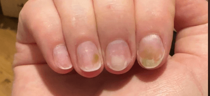 The Straight-Up Guide: Dealing with 'The Greenies' (Pseudomonas) - MOONLEE