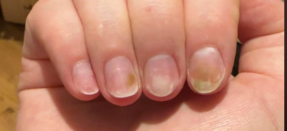 Press-on nail turning green due to Pseudomonas bacteria